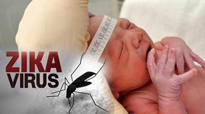Virus Zika và hội chứng teo não ở trẻ sơ sinh 1
