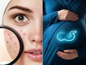 Mẹo trị nổi mụn khi mang thai cực hay 1