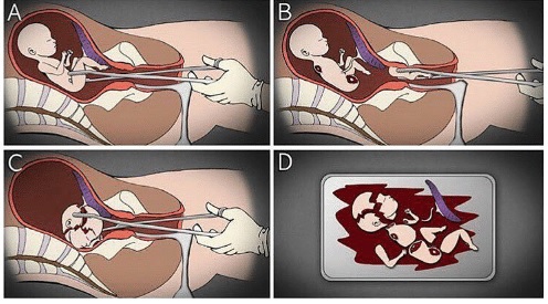 Phá thai bằng thủ thuật 2